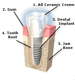 Diagram of a dental implant with labels.