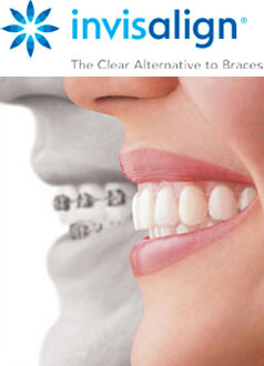 Invisalign logo followed by an image showing the comparison between regular braces and Invisalign.